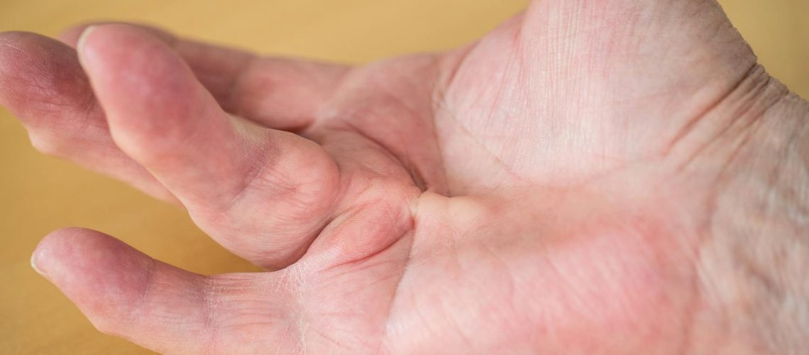 Maladie de Dupuytren : pourquoi cette déformation du doigt ?